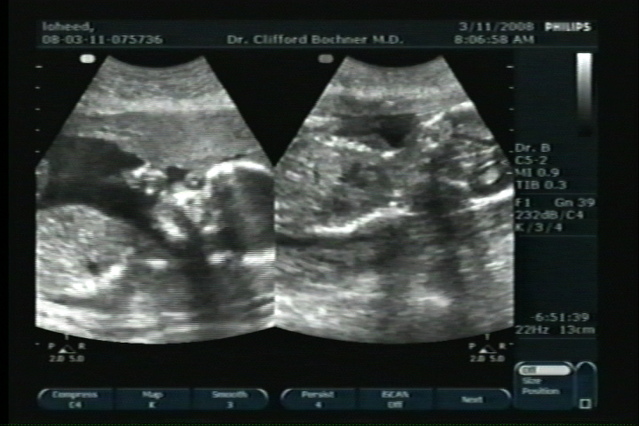 Pregnant With Twins Ultrasound 65